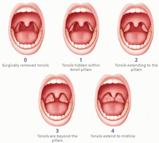 tonsil size3