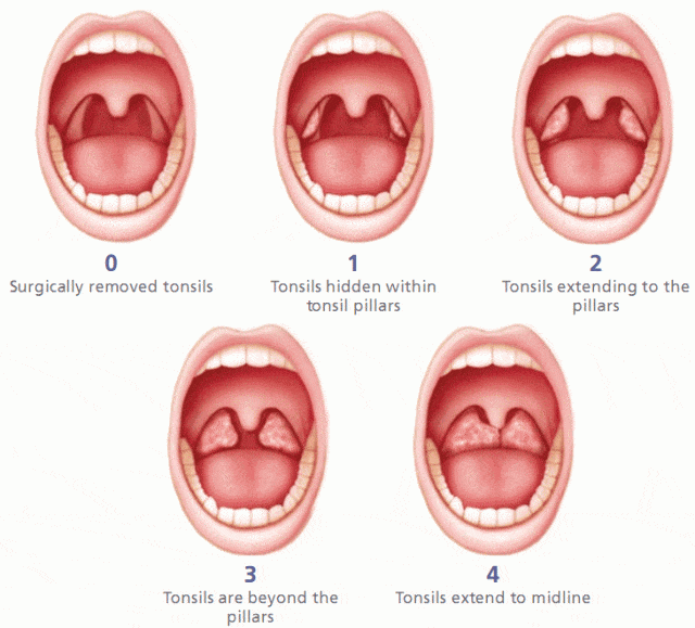 Tonsillectomy Autism And General Anesthesia The Autism Cafe