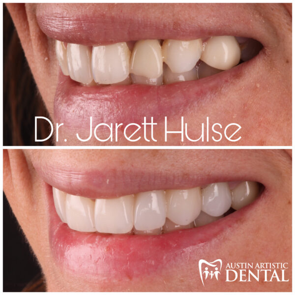 austin cosmetic dentist smile makeover dr jarett hulse