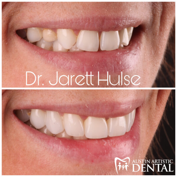 austin cosmetic dentist smile makeover dr jarett hulse