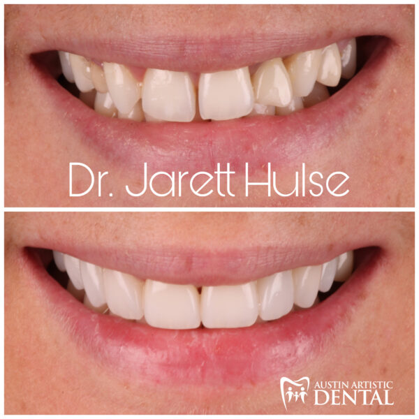 austin cosmetic dentist smile makeover dr jarett hulse